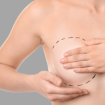 Metoda rekonstrukcji piersi z zastosowaniem tkanek własnych-tkanka tłuszczowa