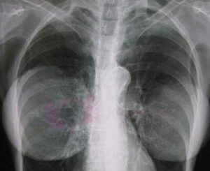 RTG- badanie rentgenowskie z implantami piersi dla wielu pacjentek po korekcji biustu wkładkami silikonowymi. Badania po operacji piersi to wielka zagadka dla pacjentek. Większość nawet nie wie, że powinna poddawać się tym bardziej badaniom. Pierwszym badaniem jest rtg, ale jak wygląd takie badanie z implantami?