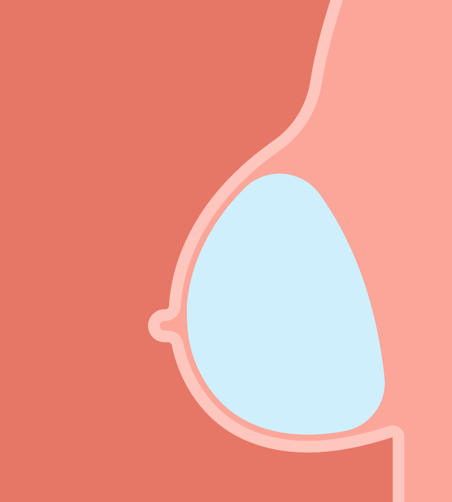 zalecenia dla pacjentek po powiększaniu piersi