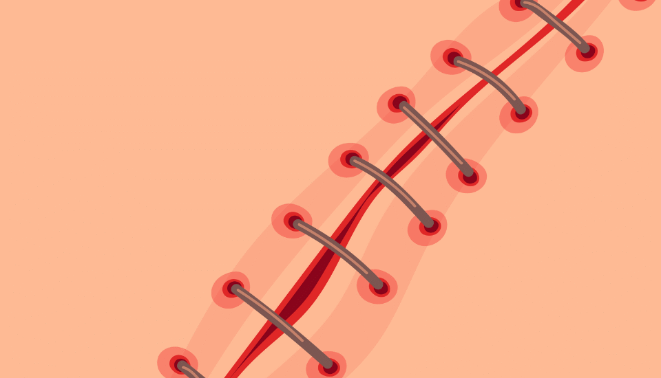 Wychodzące szwy po operacji plastycznej: czy pacjent może sam wyciągnąć lub wyciąć nitkę z blizny?